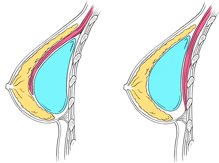 Breast Implant Procedure (Augmentation) — My Plastic Surgeon